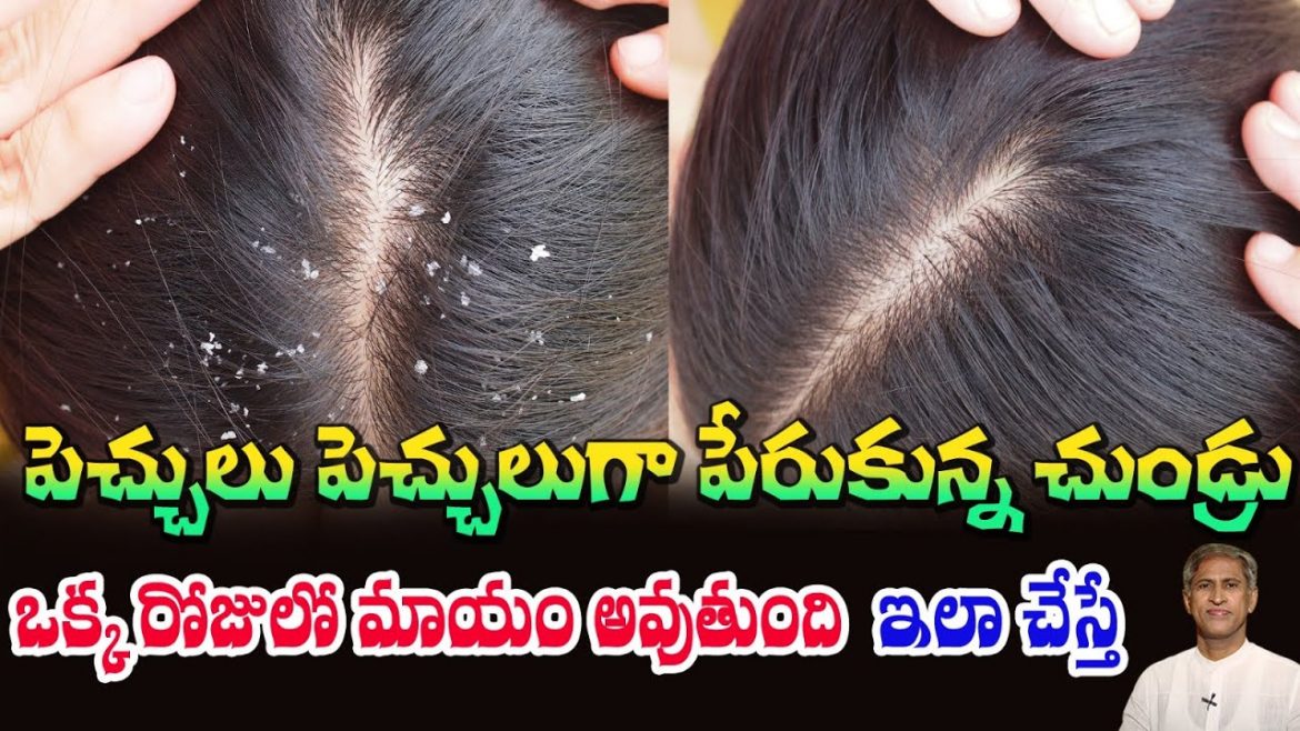 Dandruff Free Natural Remedy | అల్లం రసాన్ని జుట్టుకి రాసుకుంటే ఏమవుతుందో తెలుసా ?