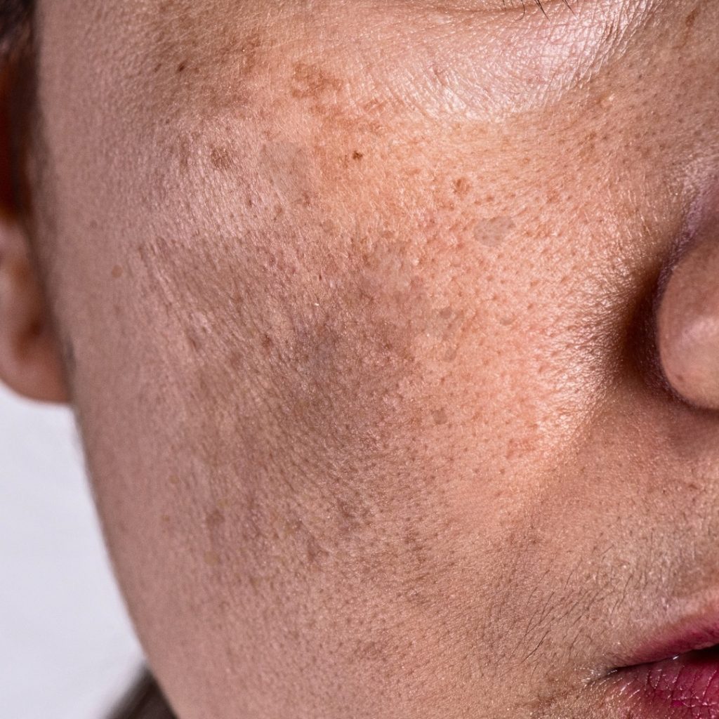 Pigmentation Remedy at Home: Remove Dark Spots Naturally